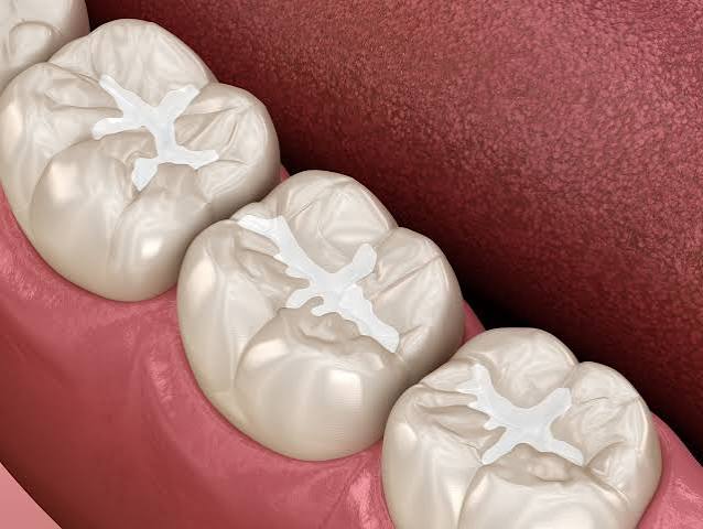 Composite fillings Kolhapur